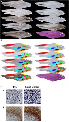 The Intratumoral Heterogeneity Reflects the Intertumoral Subtypes of Glioblastoma Multiforme: A Regional Immunohistochemistry Analysis